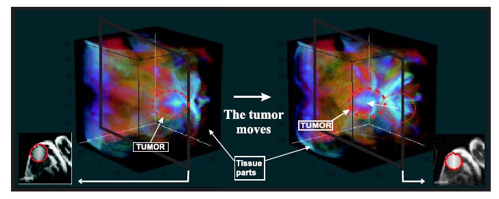 tumor synthetic images